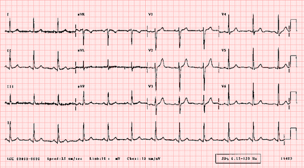 ECG